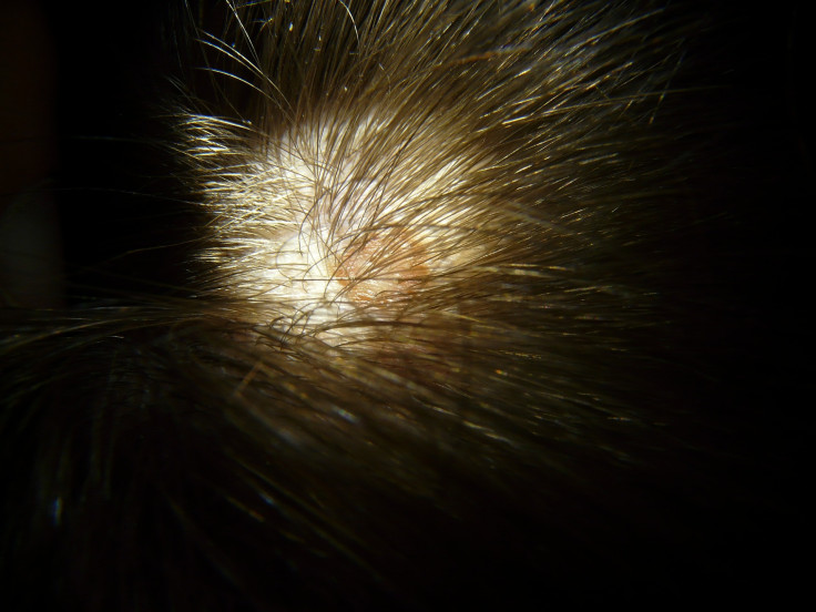 People over 30 can face dry scalp
