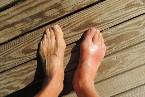 Gout is a form of arthritis characterized by swelling, redness, and tenderness in one or more joints caused due too high levels of uric acid in the body.