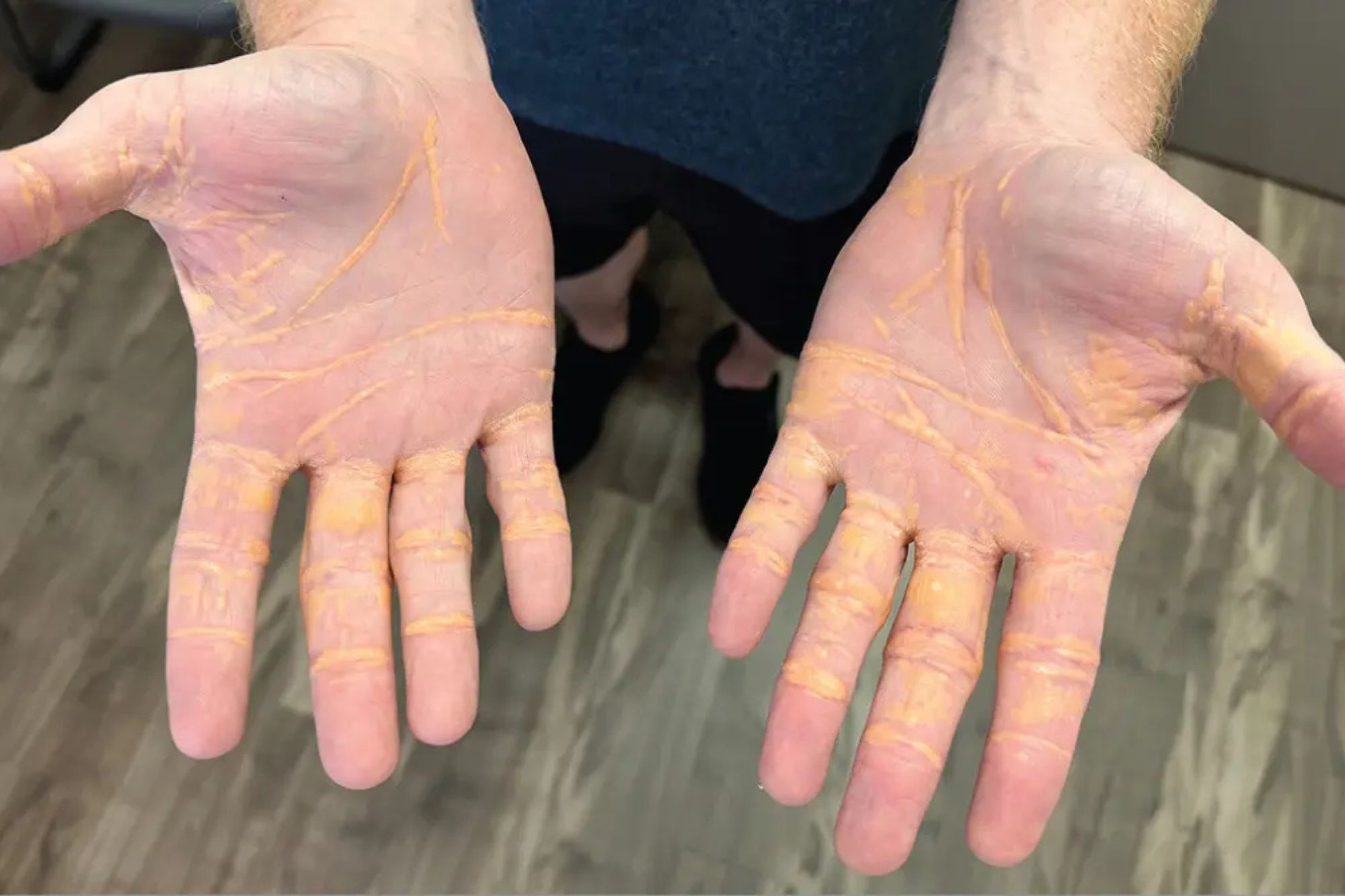 Man’s Palms Seemingly Flip Yellow After Solely Consuming Butter, Cheese and Meat in Viral ‘Carnivore Food plan’