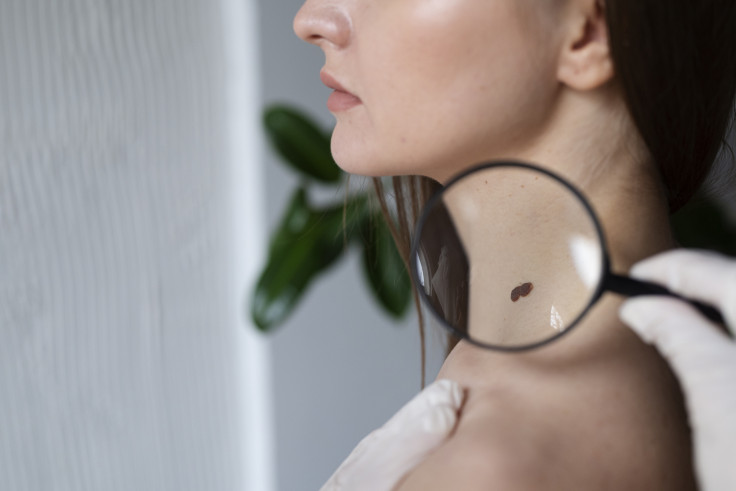 skin mole