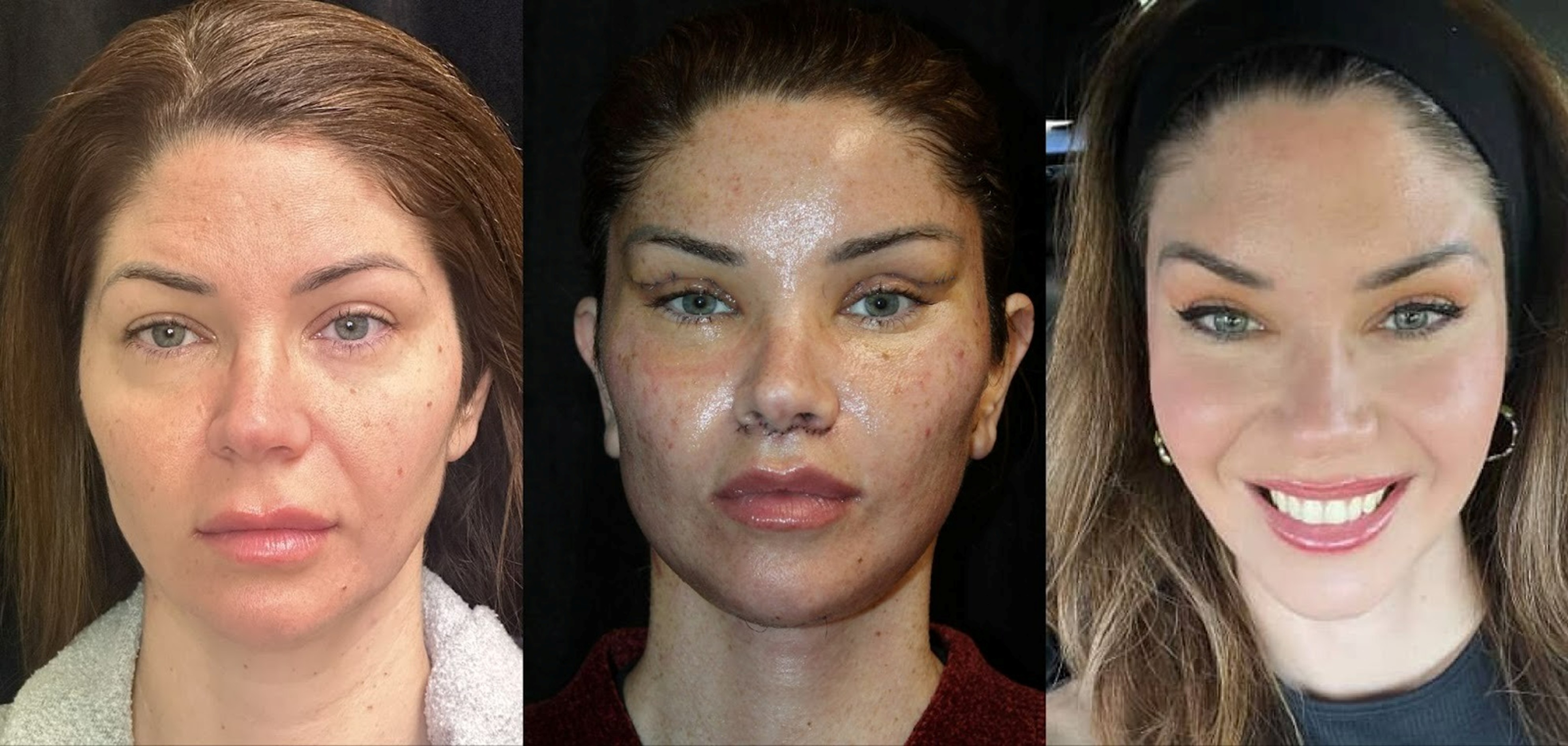 Fixing Failed Eye and Eyelid Surgery: One of the Hardest Procedures in Cosmetic Medicine with Dr. Sumeet Jindal