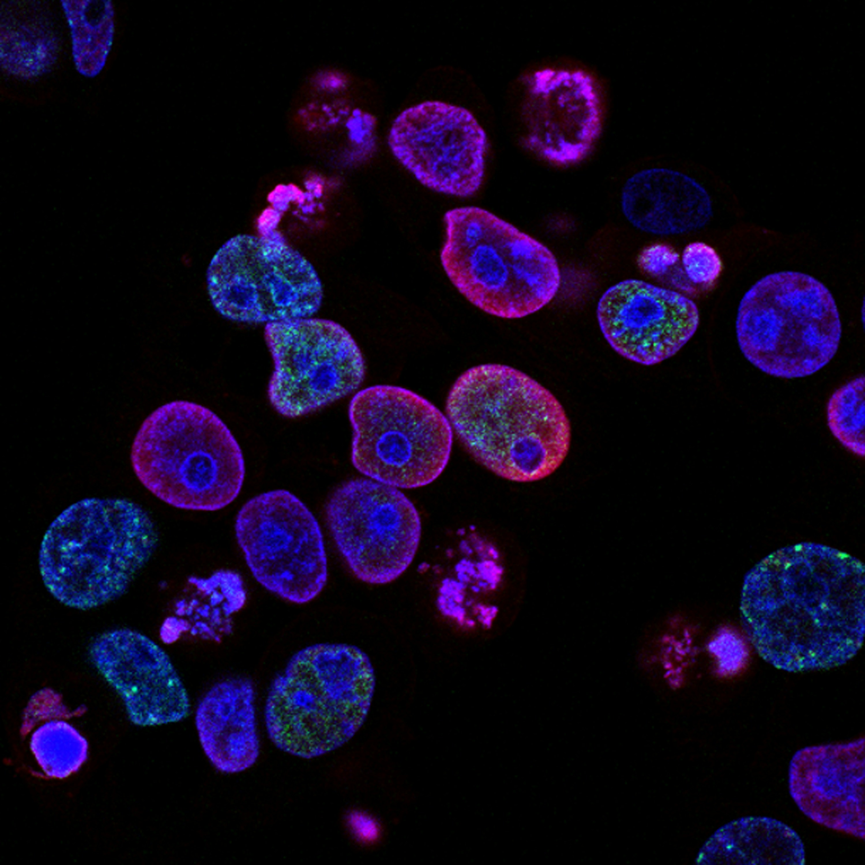 Ученые Moffitt Cancer Center изучают механизмы устойчивости опухолей к терапии