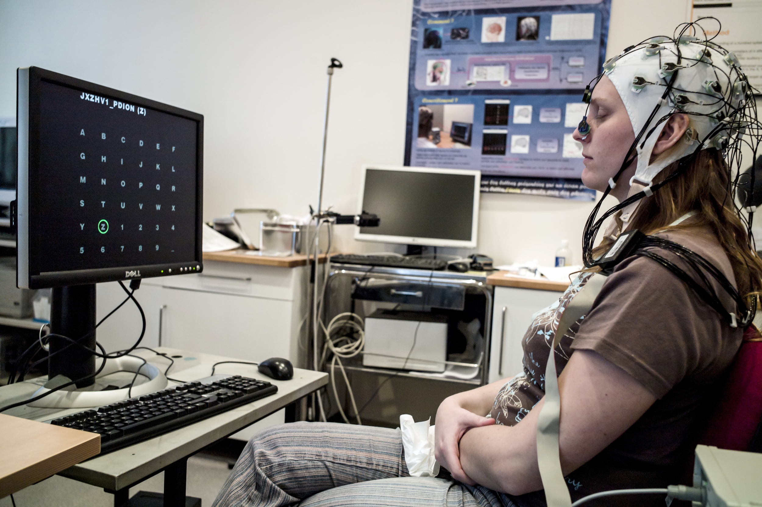 Epilepsy Patients' Own Alert Labels Helped an AI Seizure Monitor Cut False Alarms by About 80% in Simulation